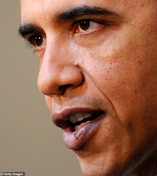Obama received dozens of small stitches to his lower lip after being hit in the face during a game of pickup basketball in the White House, in what Michelle described as an 'I told you so' moment for her
