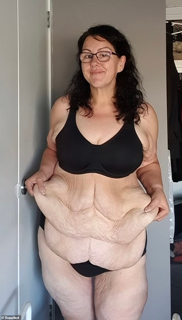 After her gastric sleeve surgery, Brenda needed to have her excess skin removed