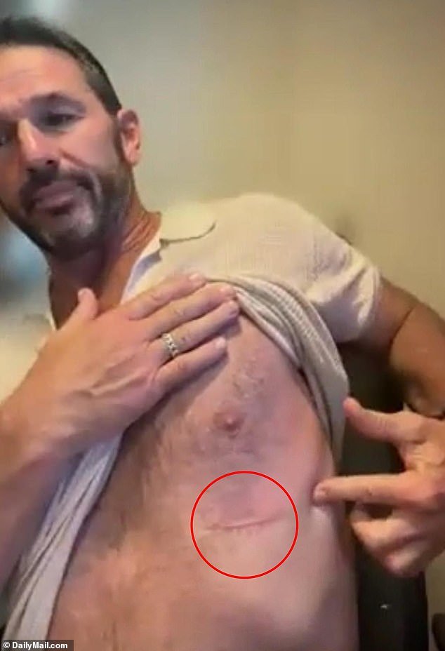 In an interview with DailyMail.com Chambers showed off his melanoma scar, which he described as being the size of a pinky finger