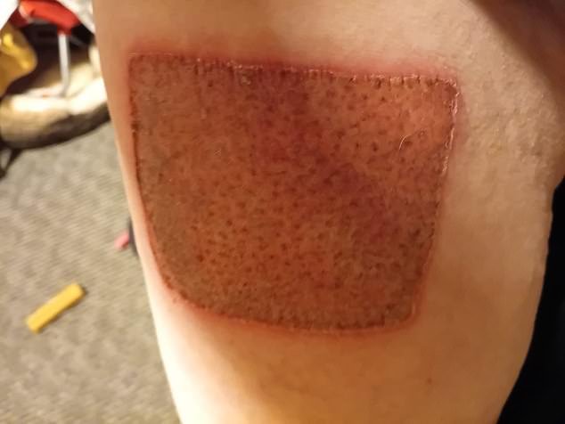 He is facing rounds of plastic surgery after undertaking a skin graft where doctors removed a chunk of skin from his leg to cover the deepest burns on his arm