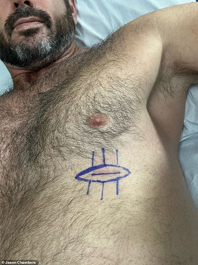 Chambers underwent two procedures to remove the sun spot from his ribs