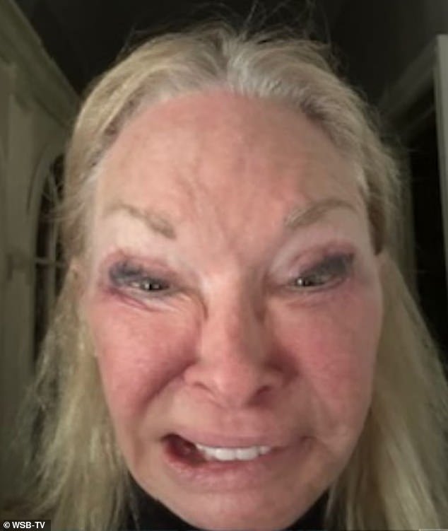 Dunham said Cole recommended a cheek lift, lip lift, eyelid and ear-pinning surgery after she told him she 'wanted to look a little refreshed'. But claims the surgery left her battling slew of side effects including right facial paralysis, the inability to close her eye, impaired eating and drinking and dry mouth